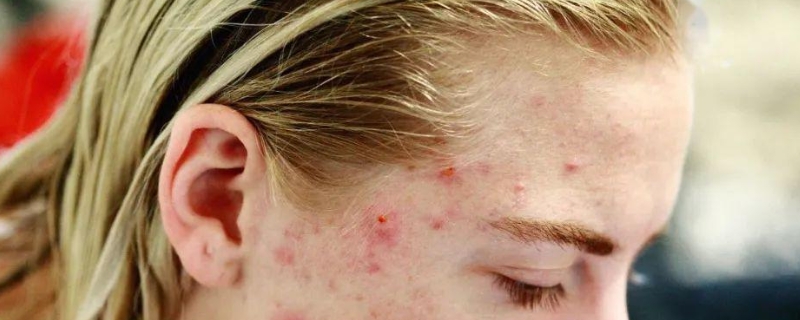 脸上长痘痘是因为什么原因引起的，怎样祛除青春痘？