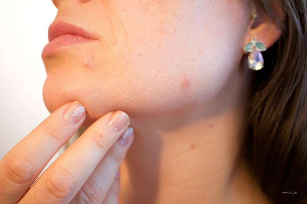 战痘攻略：化妆品中的抗痘类活性成分有哪些？