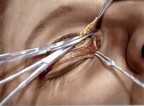 双眼皮手术时去皮去脂的量一定要适中，切不可过量