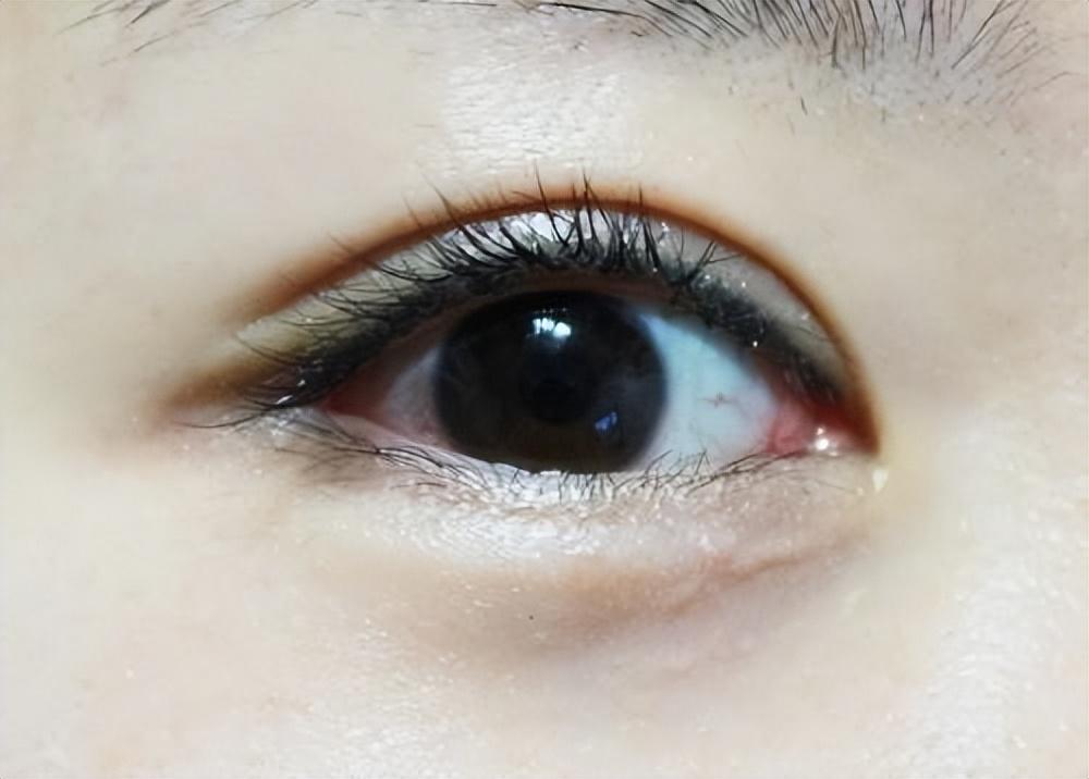 做个全切双眼皮能维持多长时间？